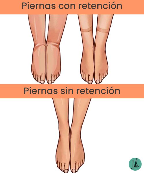 Piernas con retención de líquidos